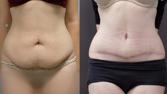 uploaded-image-pOqN-geula-prochazka-abdominoplastikadr.bartoskova - kopie